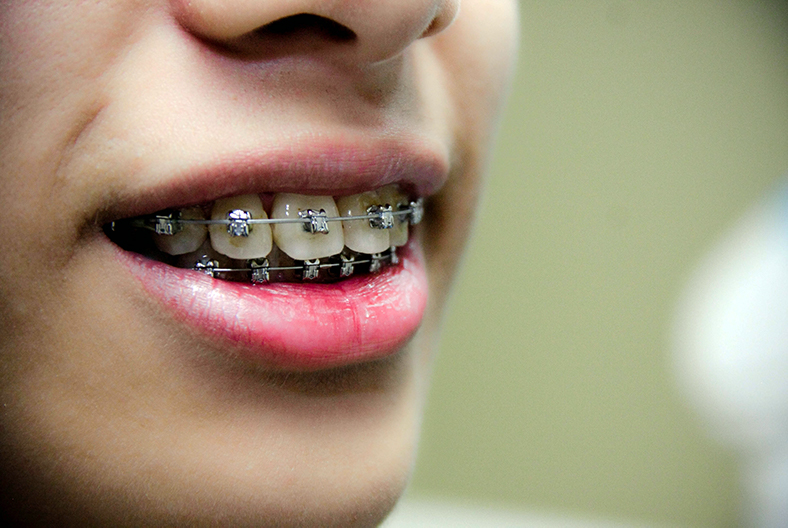 Ortodonti (Diş Teli) Tedavisinden Sonra Dişler Eski Haline Döner Mi?